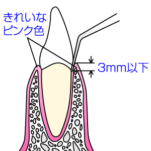 歯周病・健康な状態