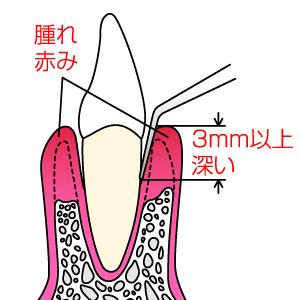 歯周病