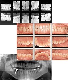レントゲン・口腔写真の撮影と分析